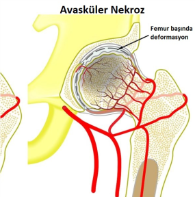 Kalça Kemiği Çürümesi ve Avasküler Nekroz Tedavisi Ortocell-f3b43c27-59af-448f-bfbd-3aa8f29be6e1